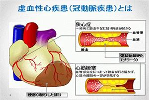 虚血性心疾患.png